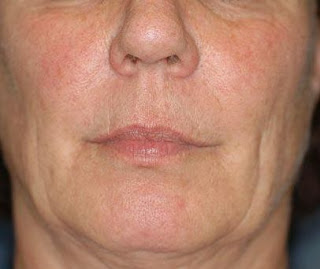 What home remedies have the same effect as face lifts?